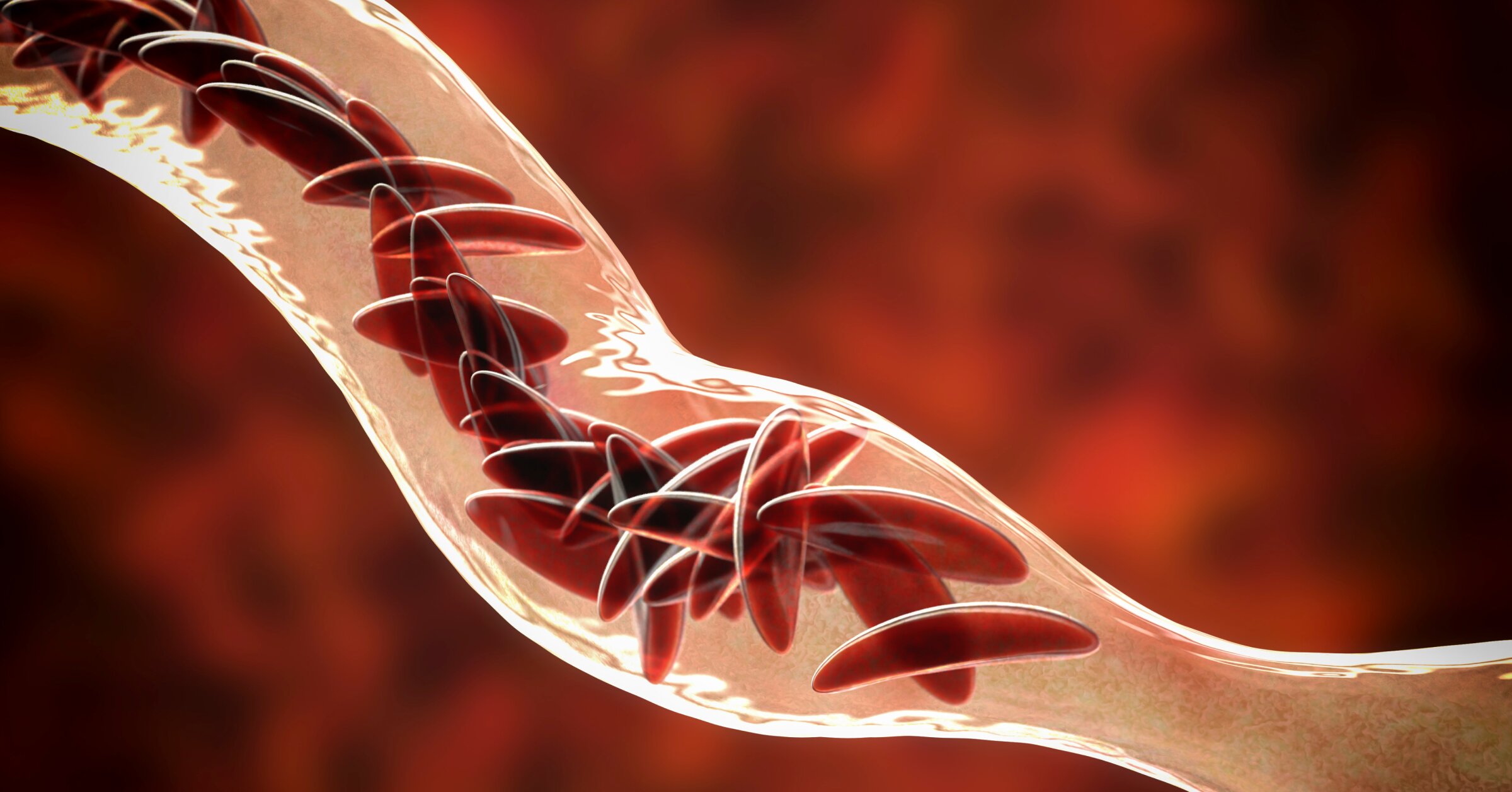 Sichelzellkrankheit: Operation am Genom? - AMBOSS Blog